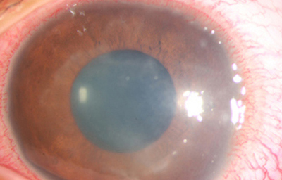 Acanthamoeba Síntomas de 15 días evolución