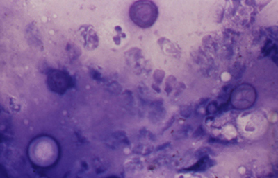 Acanthamoeba Giemsa. Original x200