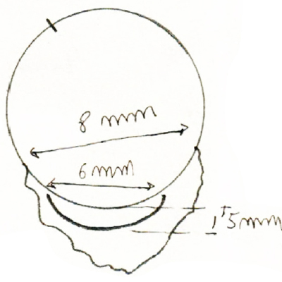 Foto 24 - Diagrama de la técnica quirúrgica