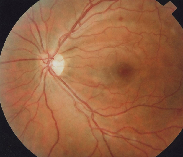 Fondo de ojo izquierdo